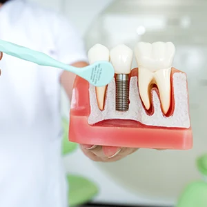 The Truth About "$399 Dental Implant" Ads